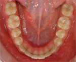 Wire retainer